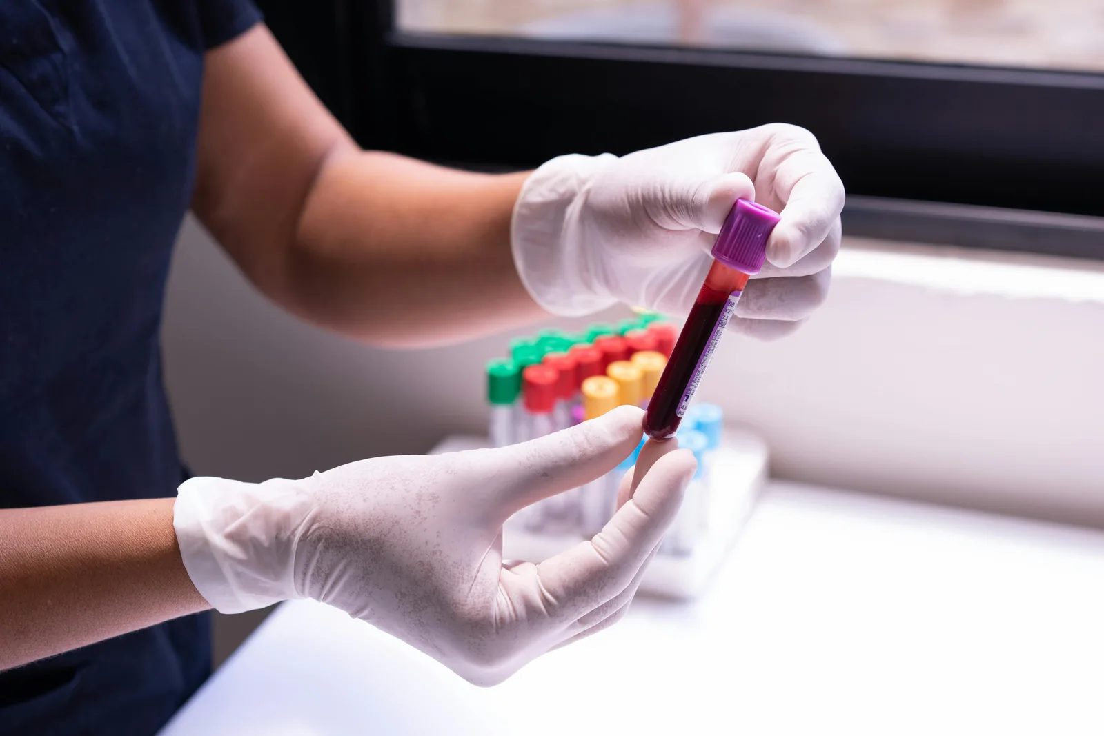 What is white blood cell count?: Gloved hands carefully handling a blood sample in a medical or laboratory environment.